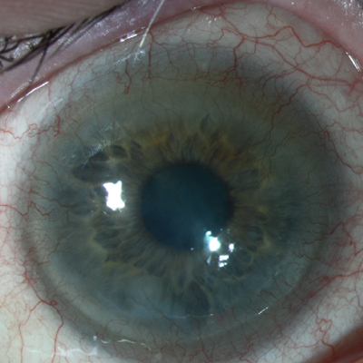 Read more about the article Applications for bevacizumab in corneal surgery