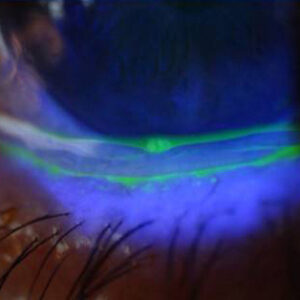 Read more about the article Recognizing, understanding, and treating conjunctivochalasis