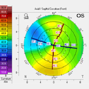 Read more about the article Using presbyopia-correcting IOLs in imperfect eyes