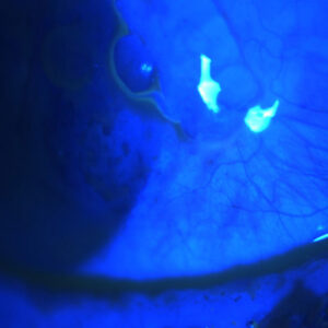 Read more about the article Infection and glaucoma surgery