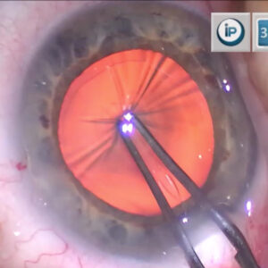 Read more about the article Recognizing zonulopathy and what to do