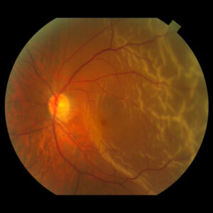 Read more about the article Evaluating the risks of retinal detachment in cataract patients