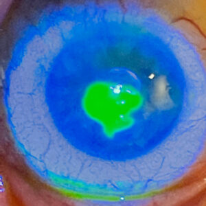 Read more about the article Breaking down neurotrophic keratitis