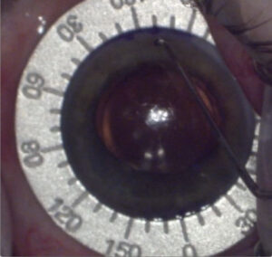 Intraoperative photo of Symfony toric lens (Johnson & Johnson Vision) undergoing rotation by 16 degrees. Limbal marks are made with use of a Mendez ring, one where the toric marks are currently sitting and the other 16 degrees away. Note that the cornea is dried thoroughly to ensure proper inking at the intended mark. Source: Brandon Baartman, MD