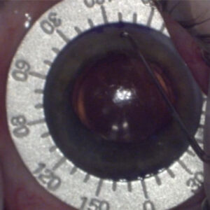 Read more about the article Toric IOL rotated—now what?