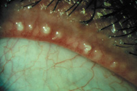 Meibomitis associated with evaporative dry eye Source: John D. Sheppard, MD