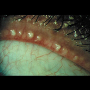 Read more about the article Treating meibomitis