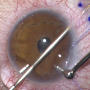 Read more about the article XEN Gel Stent: When to use and how to implant