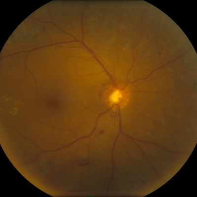 Read more about the article Cataract surgery in the diabetic patient