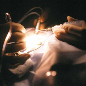 Read more about the article Eyeing post-vitrectomy cataract surgery complications