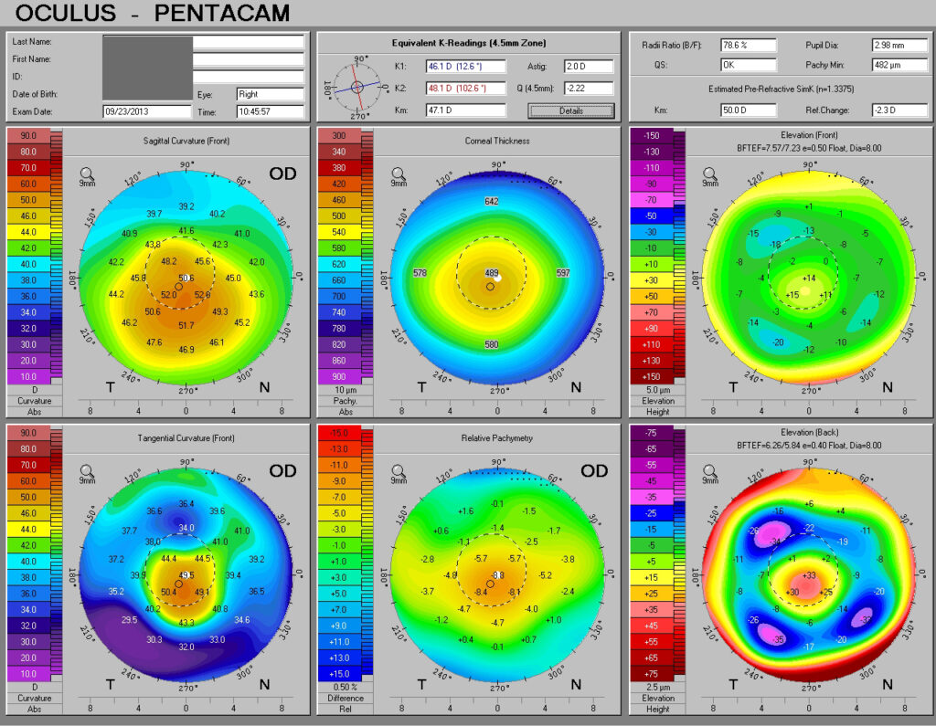 Post-crosslinking treatment. Note the flattening of steep K with stabilization of the cone. Average keratometry is unchanged.