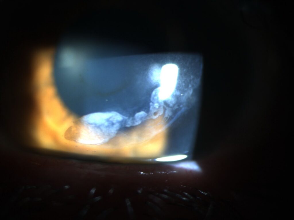 Epithelial ingrowth that occurred after a LASIK flap was relifted for an enhancement Source: Preeya K. Gupta, MD