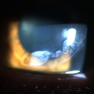 Read more about the article Eyes on PRK enhancements after LASIK