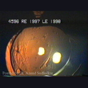 Read more about the article Post-op YAGs and standard of care