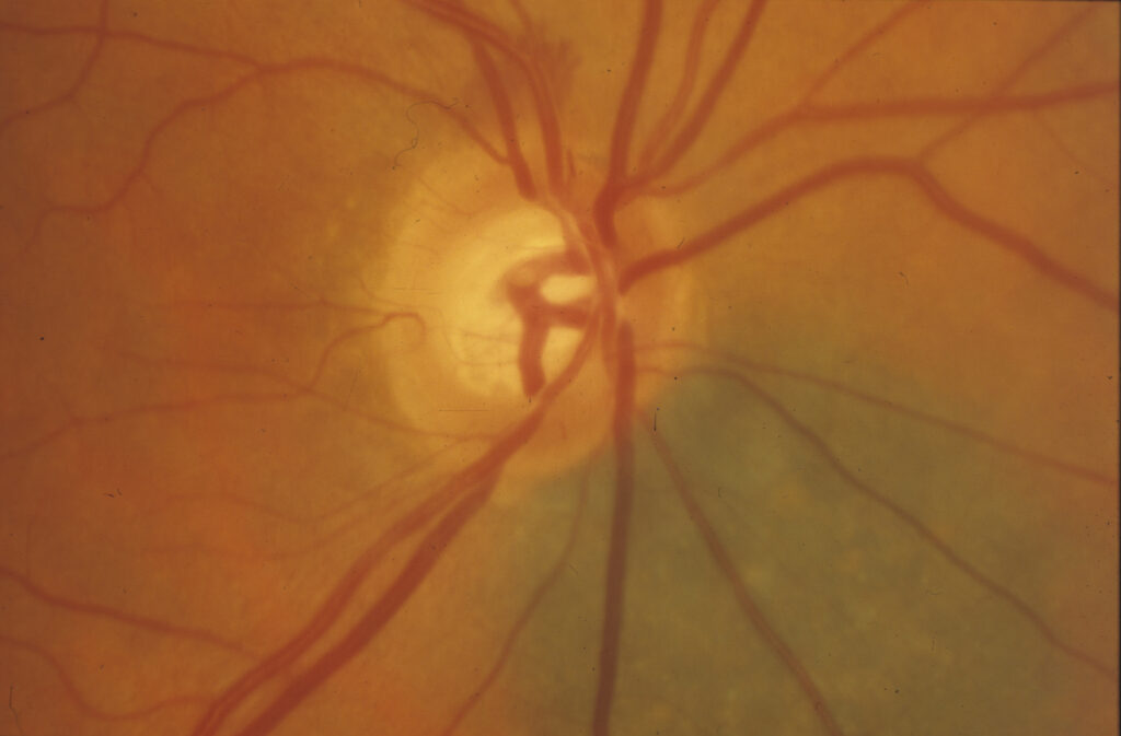 Optic disc hemorrhage at the outer rim of the optic disc at 12:00 consistent with glaucomatous process  Source: Donald Budenz, MD