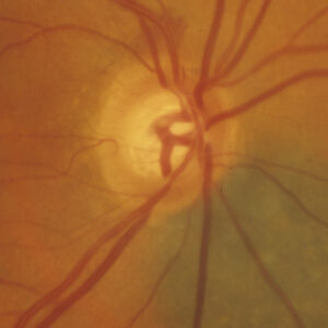 Read more about the article Optic disc hemorrhage: Don’t miss the signal