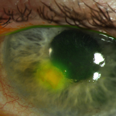 Read more about the article A look at Oxervate and treatment for neurotrophic keratitis