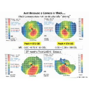 Read more about the article Don’t exclude thin cornea patients from LASIK for fear of ectasia