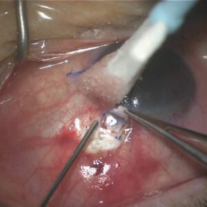 Read more about the article Examining trabeculectomy