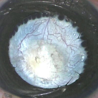 Read more about the article Surgical approach to PHPV