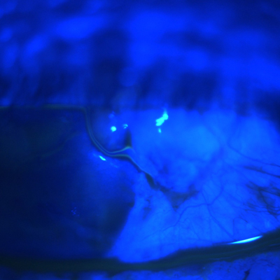 Read more about the article Handling bleb leaks