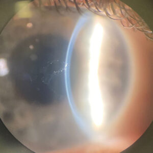 Read more about the article Identifying EBMD: Looking for blurry vision and other signs
