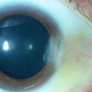 Read more about the article Looking for corneal disease prior to cataract surgery