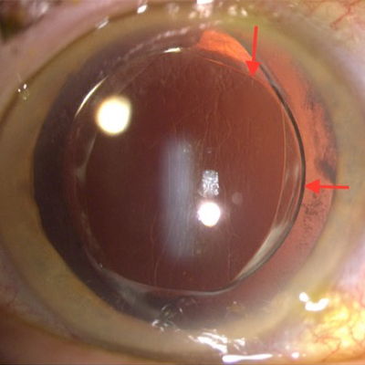 Read more about the article Negative dysphotopsia: How to explain it and management strategies