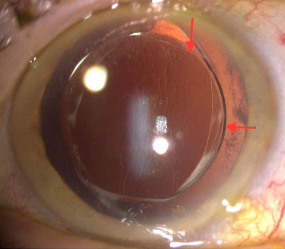 Slit lamp photo of secondary reverse optic capture with the optic prolapsed over the nasal and temporal capsule and the haptics in the capsule bag Source: Nicole Fram, MD