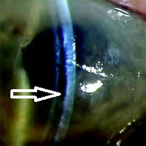 Read more about the article Graft detachments in DSAEK and DMEK