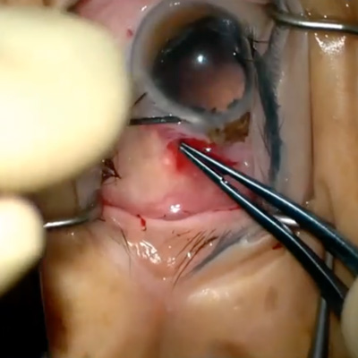 Read more about the article Preventing and managing iris prolapse