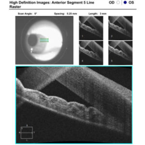 Read more about the article Get ahead of malignant glaucoma in high-risk eyes