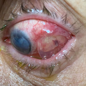 Read more about the article Tube shunt erosion/exposure