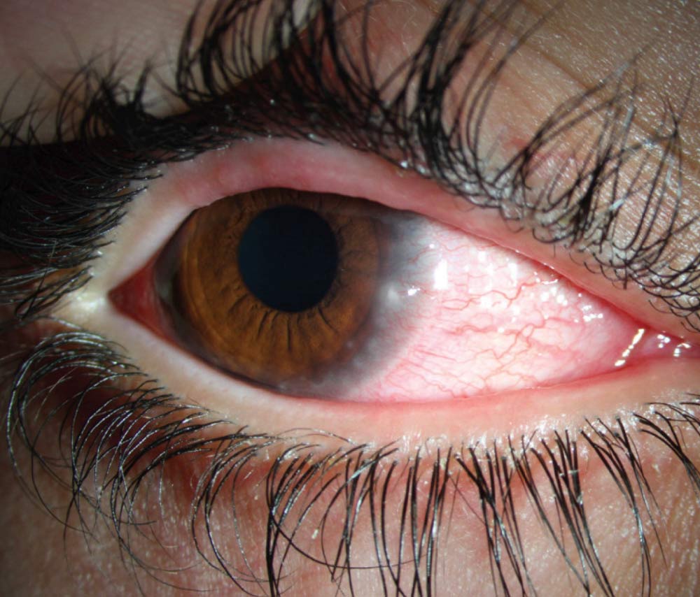 Slit lamp photo of 8-year-old girl, right eye; marked lid margin  inflammation, upper eyelid greater than lower with clogged  meibomian glands; marked conjunctivitis and peripheral keratitis