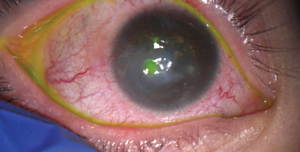 Examination under anesthesia of 10-year-old girl, right eye; marked meibomian gland inspissation, lid margin inflammation, and conjunctivitis; old corneal scars and active areas of corneal epithelial breakdown and ulceration Source (all): Gerami Seitzman, MD