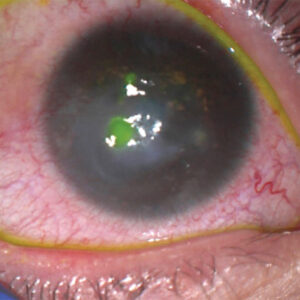 Read more about the article MGD in the pediatric population