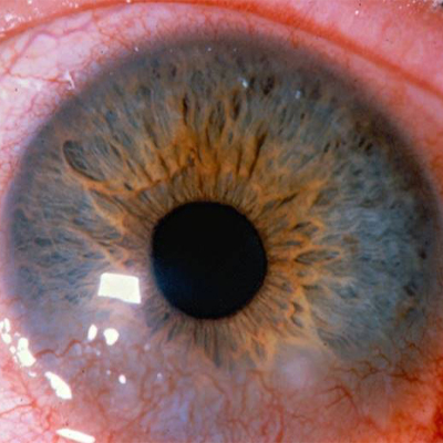 Read more about the article Signs of rosacea and how to treat