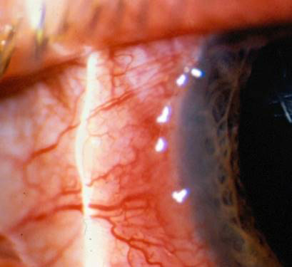 Peripheral keratitis in rosacea Source (all): Vincent de Luise, MD