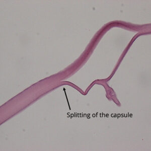 Read more about the article What you need to know about “dead bag syndrome”