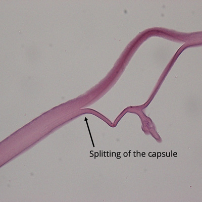 Read more about the article What you need to know about “dead bag syndrome”