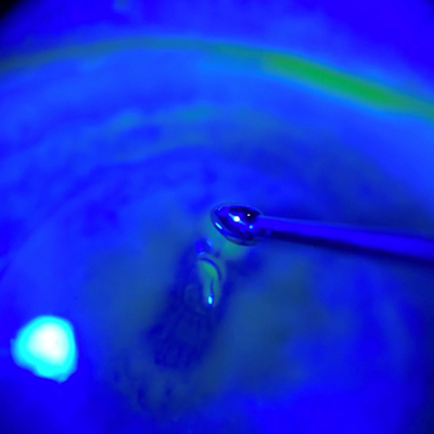 Read more about the article Corneal sweep test for recurrent corneal erosion