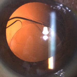 Read more about the article Spontaneous lens dislocation: why it occurs, when, management, and other insights