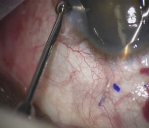 The XEN Gel Stent has been marked at the tip and is implanted under the conjunctiva with the ab interno approach. Source (all): Constance Okeke, MD