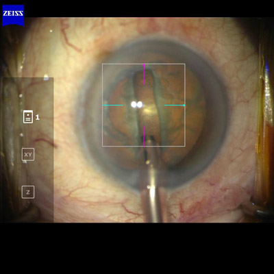 Anterior segment OCT for cataract surgery: preop, intraop, and postop  applications - EyeWorld
