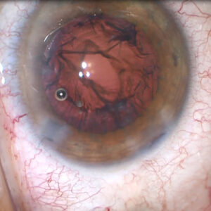 Read more about the article Posterior capsule rupture: How to proceed and lens options