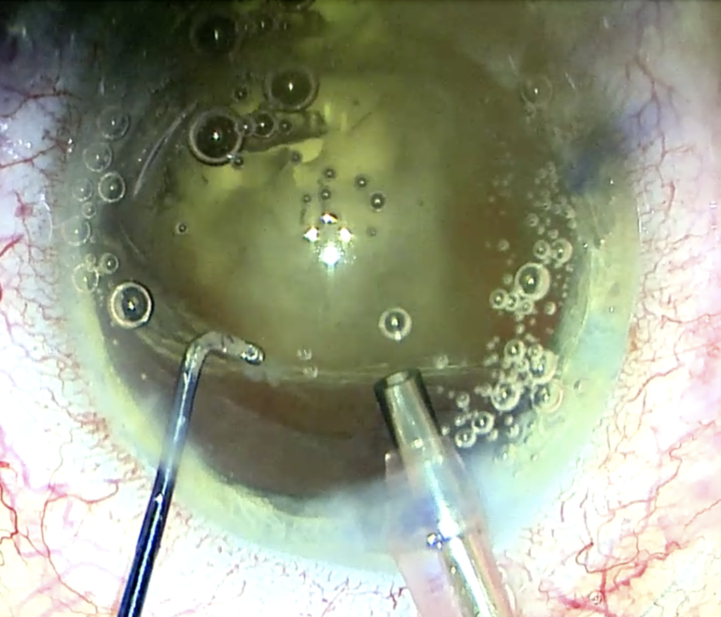 This shows posterior dislocation of the entire lens nucleus in a post-vitrectomized eye after a large posterior capsular rupture.  Source: Nandini Venkateswaran, MD
