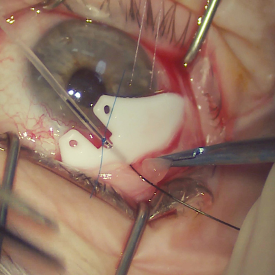 Read more about the article Non-valved tube implants: Comparison of different devices and size options