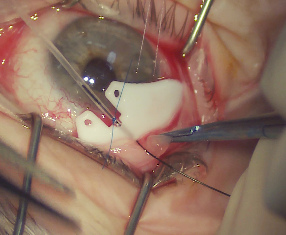 This is an intraoperative photo of the 250 ClearPath prior to inserting the implant in the superior temporal quadrant. Again, this implant was tied off on the back table with a 7-0 Prolene suture and a 4-0 nylon rip cord. Source (all): Davinder Grover, MD