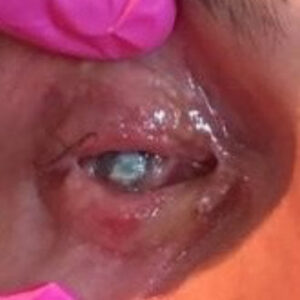 Read more about the article Successful corneal transplant after ‘freak fireworks accident’