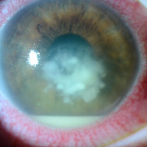 Read more about the article Taking a closer look at fungal keratitis